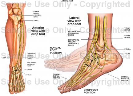 Foot Drop Position Comparison