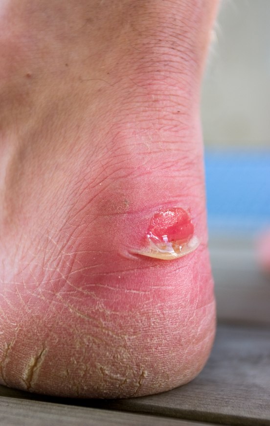 Blister on foot